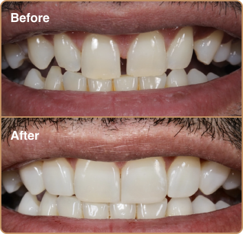 Close a diastema with composite bonding