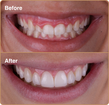 Gum contouring and composite bonding before and after