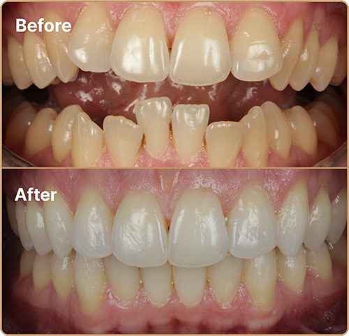 Invisalign before and after