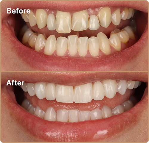 Composite bonding missing teeth