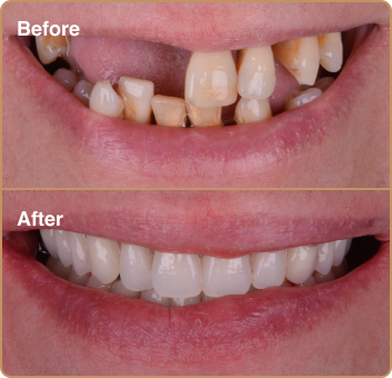 dental implant before and after