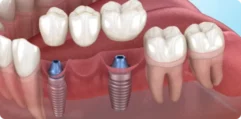 Bridgework-with-implants-1