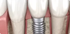 Dental-Implants-1